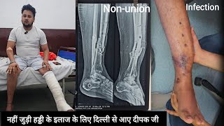 Tibia bone fracture Nonunion infected fracture ke ilaj ke liye Delhi se Deshwar Hospital Bharatpur 