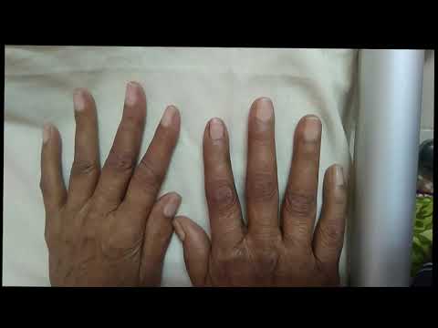 Video: Terry's Nails: Bilder, Ursachen, Behandlung, Vs. Lindsays Nägel