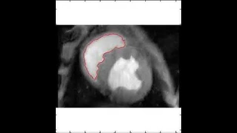 modifiedChanVese_heartReducedUpperLeft.avi