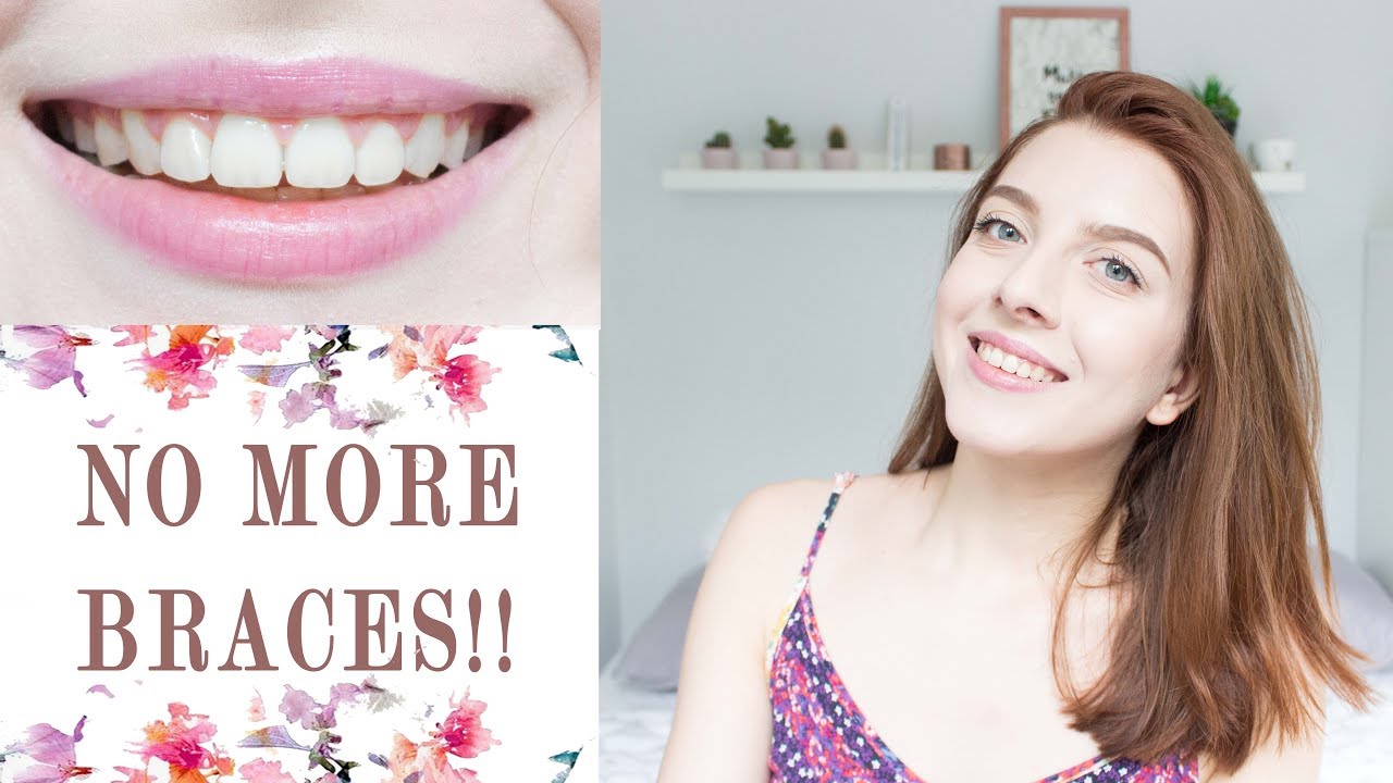 ☆БРЕКЕТИ☆ Края на лечението, премахване и ретейнъри