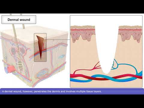 Video: Cum să vindeci crusta de răni: 10 pași (cu imagini)