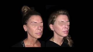 Facelift, fat grafting and lip lift before & after results: Dr David Sharp