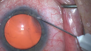 iTrack™ Surgical Pearls: Creating the Paracentesis