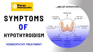 Homeopathy For Hypothyroidism: Symptoms, Treatment, And Causes