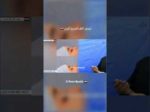 تجميل الانف اليمنى دحسام ممدوح مصر