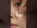 STOP TOUCHING YOUR PIMPLES #skincare #skincaretips #acne #pimple #pimplepatch #acnetips #glowingskin