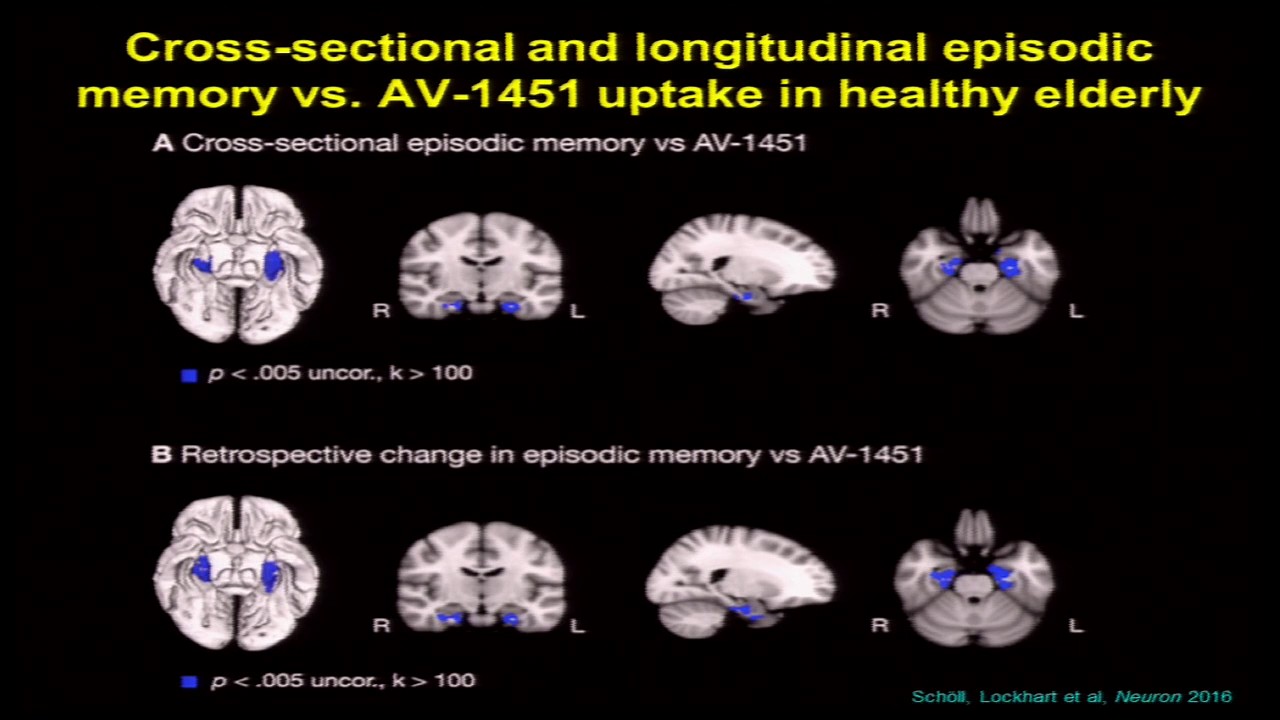 aging research conference Cognitive Aging Summit III | Dr. William Jagust | Age-Related Pathology, Cognition, and Resilience