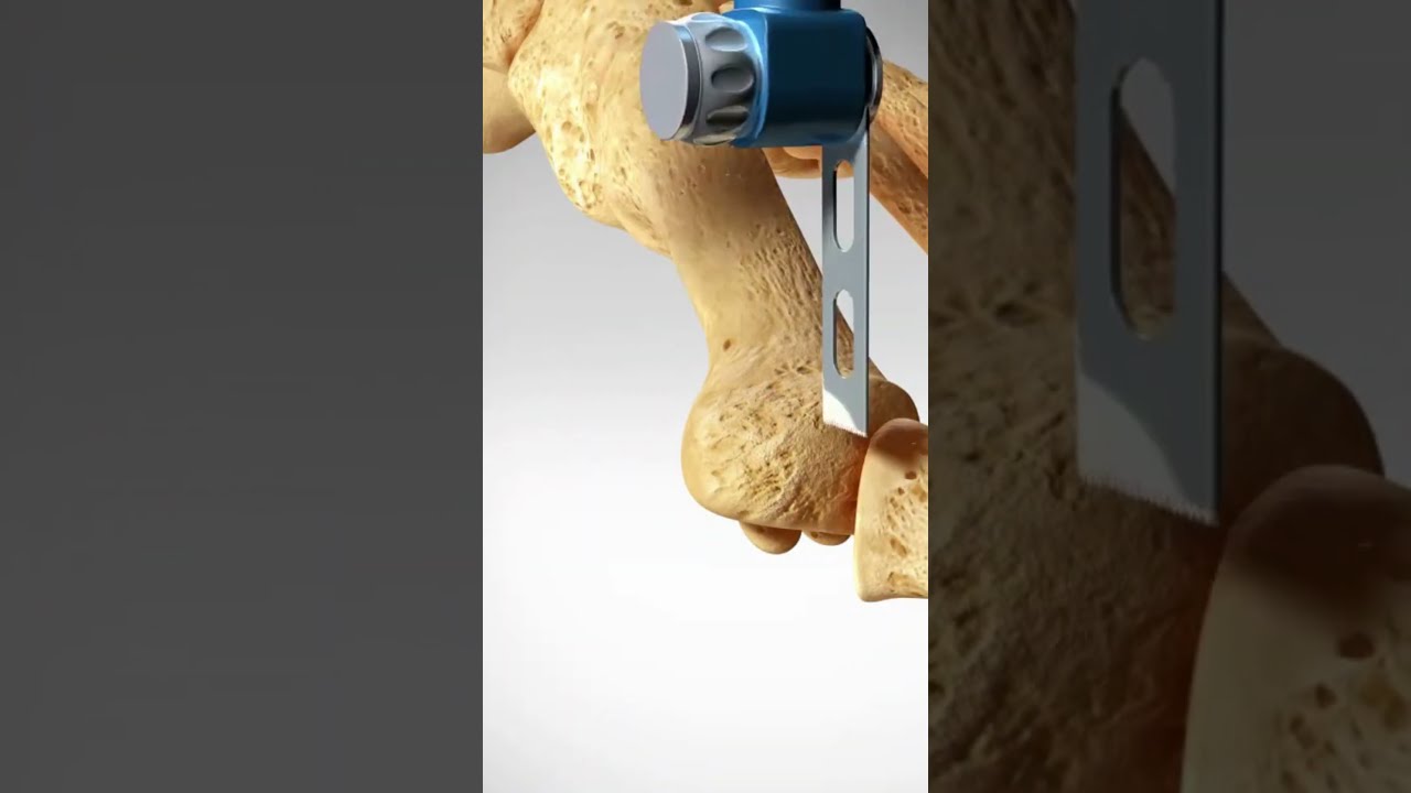 See How A Bunion Is Treated Bunionectomy With Osteotomy Toes Foot Feet