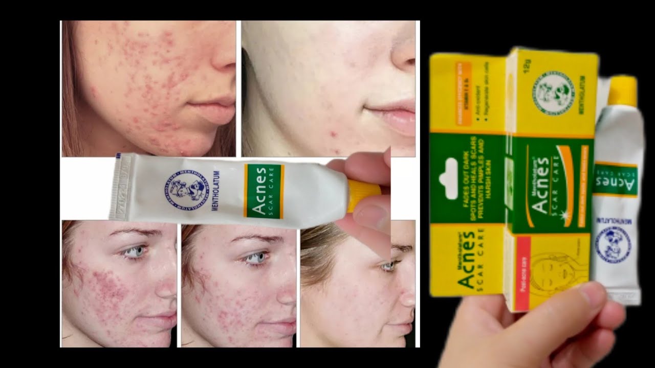 ACNES SCAR CARE Cream to get Rid of Acne Acne Scars Dark spots