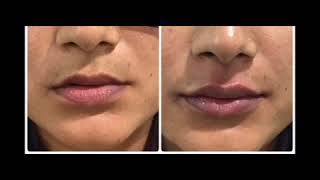 Botox Injection In Vitals Klinic, Bangalore Fillers Treatment In Karnataka Dermatologist India