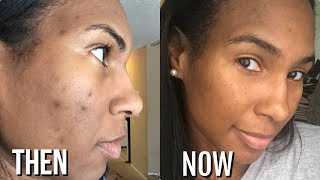 drunk elephant dark spot remover