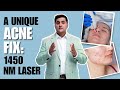 A Unique Acne Fix: 1450 NM Laser ✨