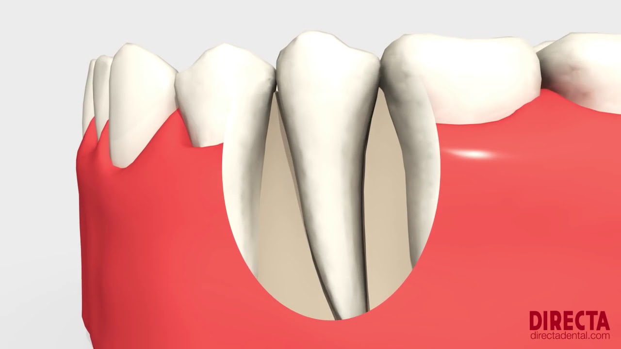 Luxator® LX by Directa   Mechanical Periotome by Directa