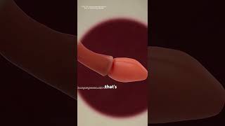 Hirschsprung disease explained (3D animation) #science #slipdiscsurgery #3danimation #anatomy