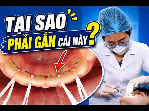 Gắn Hàm Duy Trì Mặt Trong Cần Thiết Không? Quy Trình Gắn Hàm Duy Trì Thế Nào?