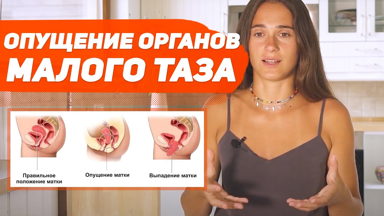 КАК ОПРЕДЕЛИТЬ ОПУЩЕНИЕ ОРГАНОВ МАЛОГО ТАЗА ? - YouTube