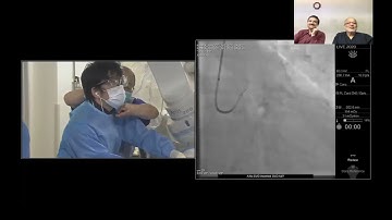 Coronary Orbital Atherectomy in OCT Live in Kamakura