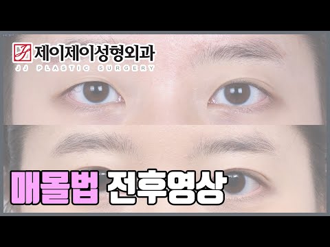 <strong>매몰법</strong> 재수술 전후영상 - 제이제이성형외과