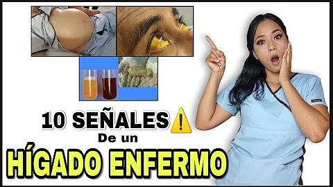 ¿Cuáles son los primeros síntomas de un hígado enfermo?