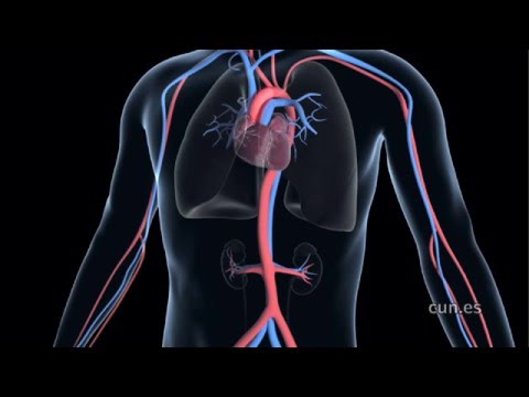 Vídeo: Aneurisma de aorta