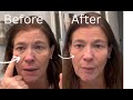 7 to 9 minutes my under eye bags are gone!Instant Under Eye Lift Serum - Reduces Eye Bags, Wrinkles,