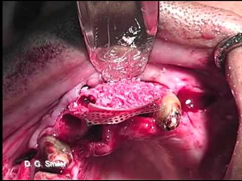 Titanium Mesh Graft to Anterior Maxilla