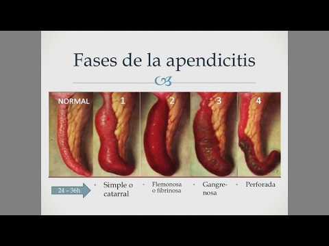 Vídeo: Apendicitis Catarral