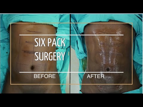 SIX PACK SURGERY | ABDOMINAL ETCHING | OP. DR. YUCEL SARIALTIN