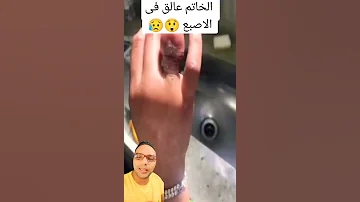 مش هتصدق عملوا ايه عند إزالة الخاتم العالق في الإصبع UNBELIEVABLE RING STUCK ON FINGER Shorts 