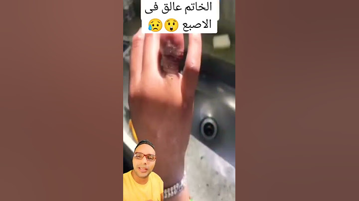 مش هتصدق عملوا ايه عند إزالة الخاتم العالق في الإصبع  UNBELIEVABLE RING STUCK ON FINGER  #shorts