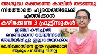 വെരികോസ് വൈനിനെ അലിയിച്ചു ഇല്ലാതാക്കാം ഇഞ്ചി ഇങ്ങനെ കഴിച്ചാൽ മതി | VERICOSE VEIN TREATMENT