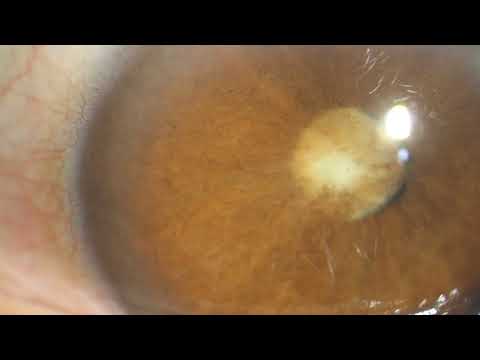 Traumatic Cataract and