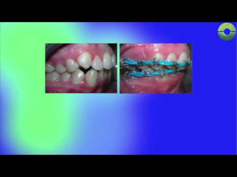 Ortodoncia en los jóvenes. Dr. Alberto Castrejon ortodoncia mexicali