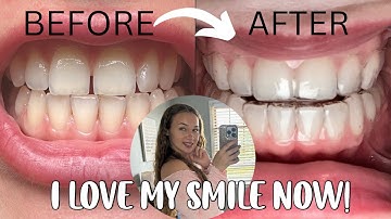 BYTE Aligners Unboxing | Before And After Results