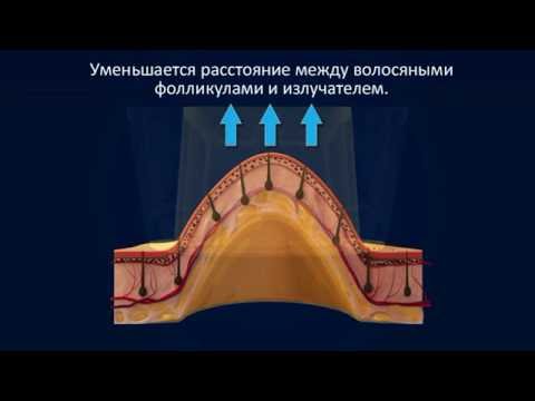 Лазерная эпиляция Light Sheer DUET Лазерная эпиляция Light Sheer DUET