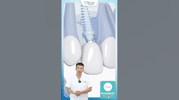Cấy Implant Khi Bị Mất Răng | Bác Sĩ Yên