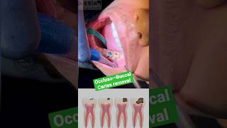 إزالة تسوس الاسنان في ٢٠ ثانيه | Dental Caries Removal Occluso-Buccal