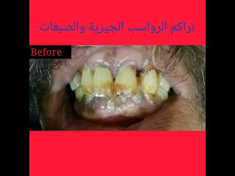 الأسنان شكلها اتغير 180 درجة لدرجة إنه صاحب الحالة مكانش مصدق إن دي أسنانه من كتر الفرحة