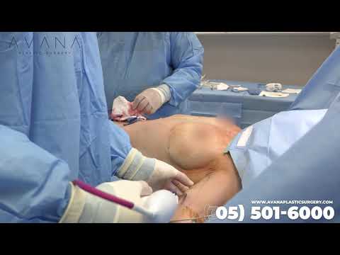 HD Liposuction with J-Plasma by Dr Moradian