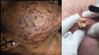TOUGH REMOVAL BLACKHEAD ON THE FACE EASY REMOVE BLACKHEADS IN 2 MINUTE