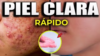 Cómo Eliminar El Acné Y Tener Piel Clara