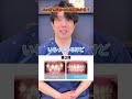 3ヶ月でインビザライン矯正って終わるの？#インビザライン #スピード矯正 #dental #Aクリニック #歯医者