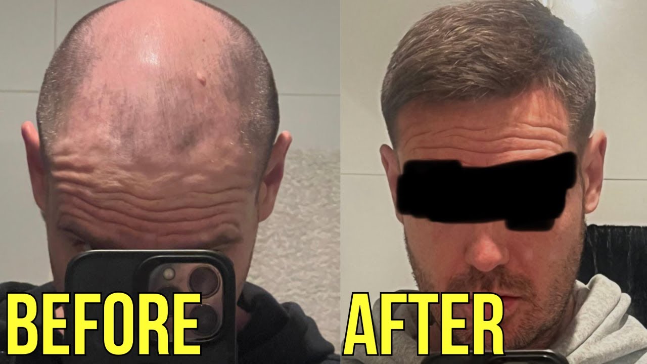 HOW HE REVERSED HIS RECEDING HAIRLINE IN 12 MONTHS..**UNBELIEVABLE**