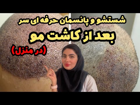 آموزش شستن و پانسمان بعد از کاشت مو در خونه