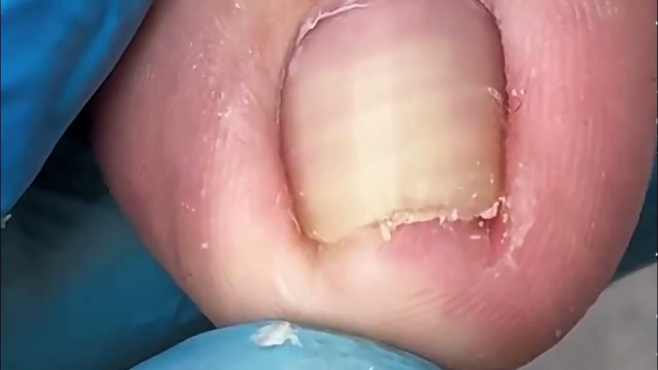 How To Remove Dirt and Ingrown Toenails at Home YouTube