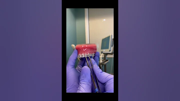 How Do Braces Work?