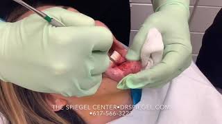 Chin Augmentation At The Spiegel Center- Implant