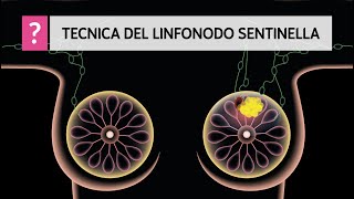 Cos’è un linfonodo sentinella e come si identifica?