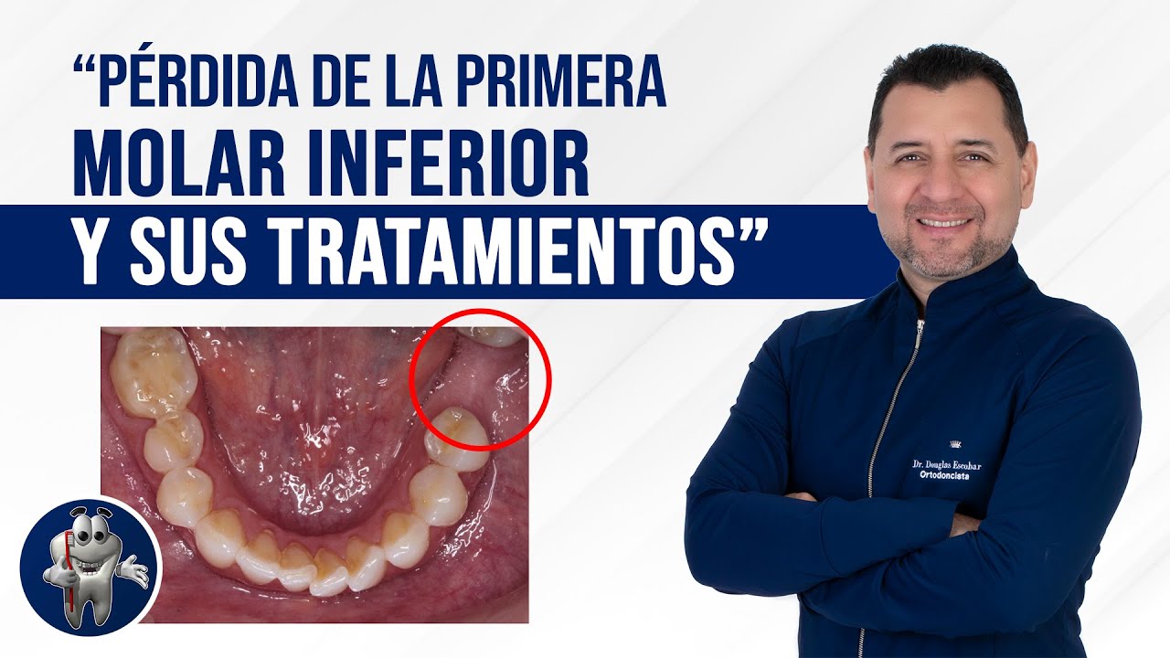 P RDIDA DE LA PRIMERA MOLAR INFERIOR Y SUS TRATAMIENTOS ENTREVISTA p-rdida-de-la-primera-molar-inferior-y-sus-tratamientos-entrevista