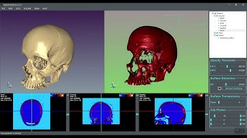 DICOM Images to 3D Mesh Conversion using Real3d VolViCon